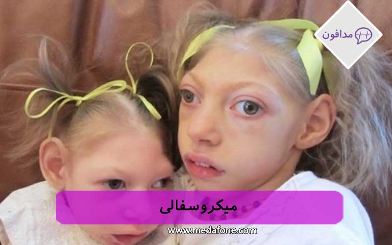 میکروسفالی
