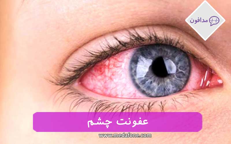 عفونت چشم