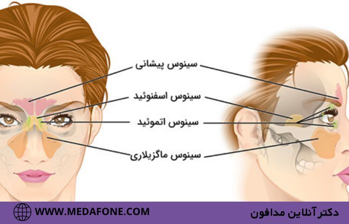 سینوزیت