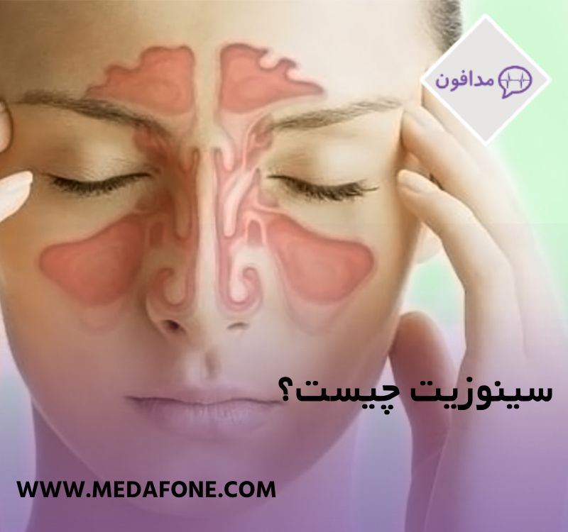 سینوزیت چیست؟