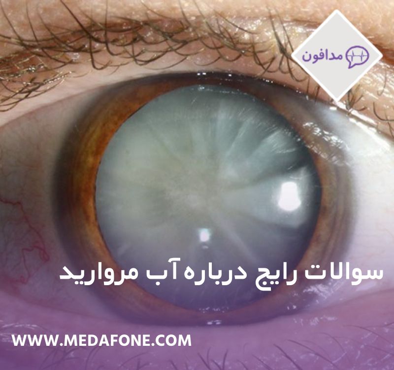سوالات رایج آب مروارید