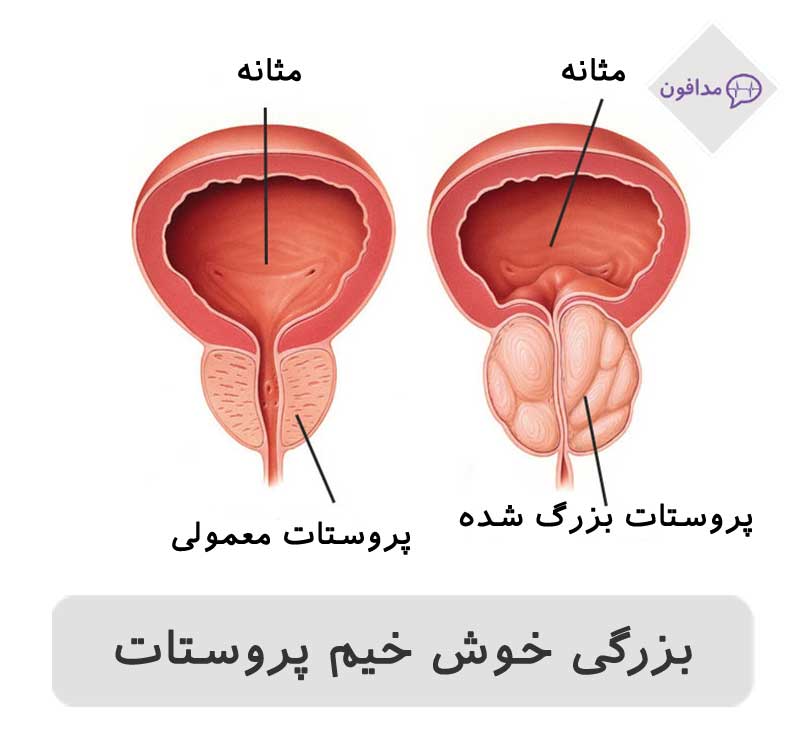 بزرگ شدن پروستات