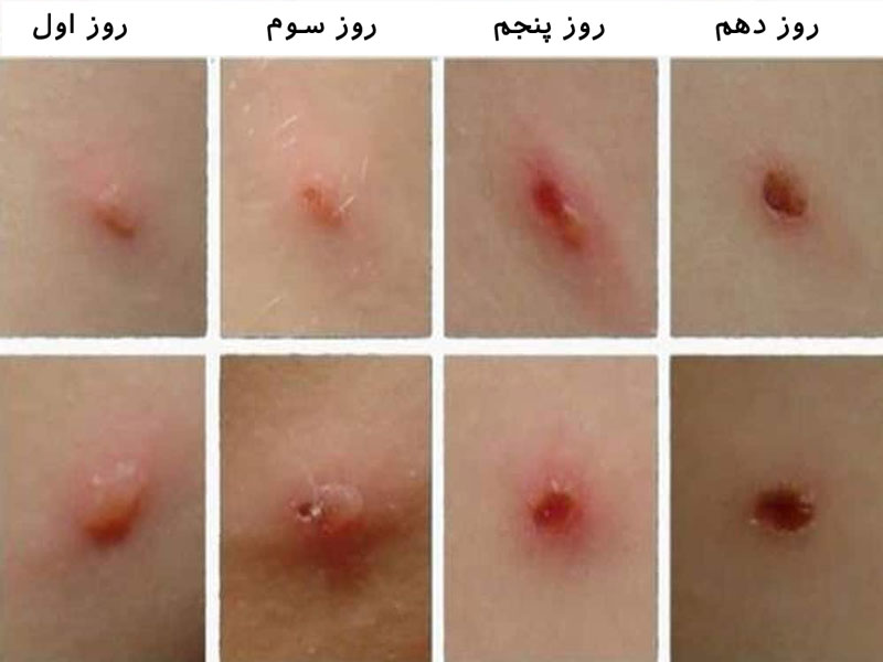 آبله مرغان در کودکان، تغذیه، پرسش و پاسخ