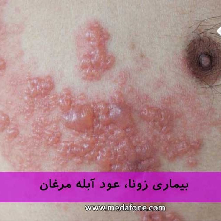 فواید بیماری زونا